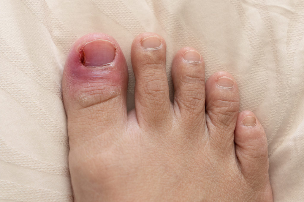 Ingrown Toenails Marie Whitfield Podiatry