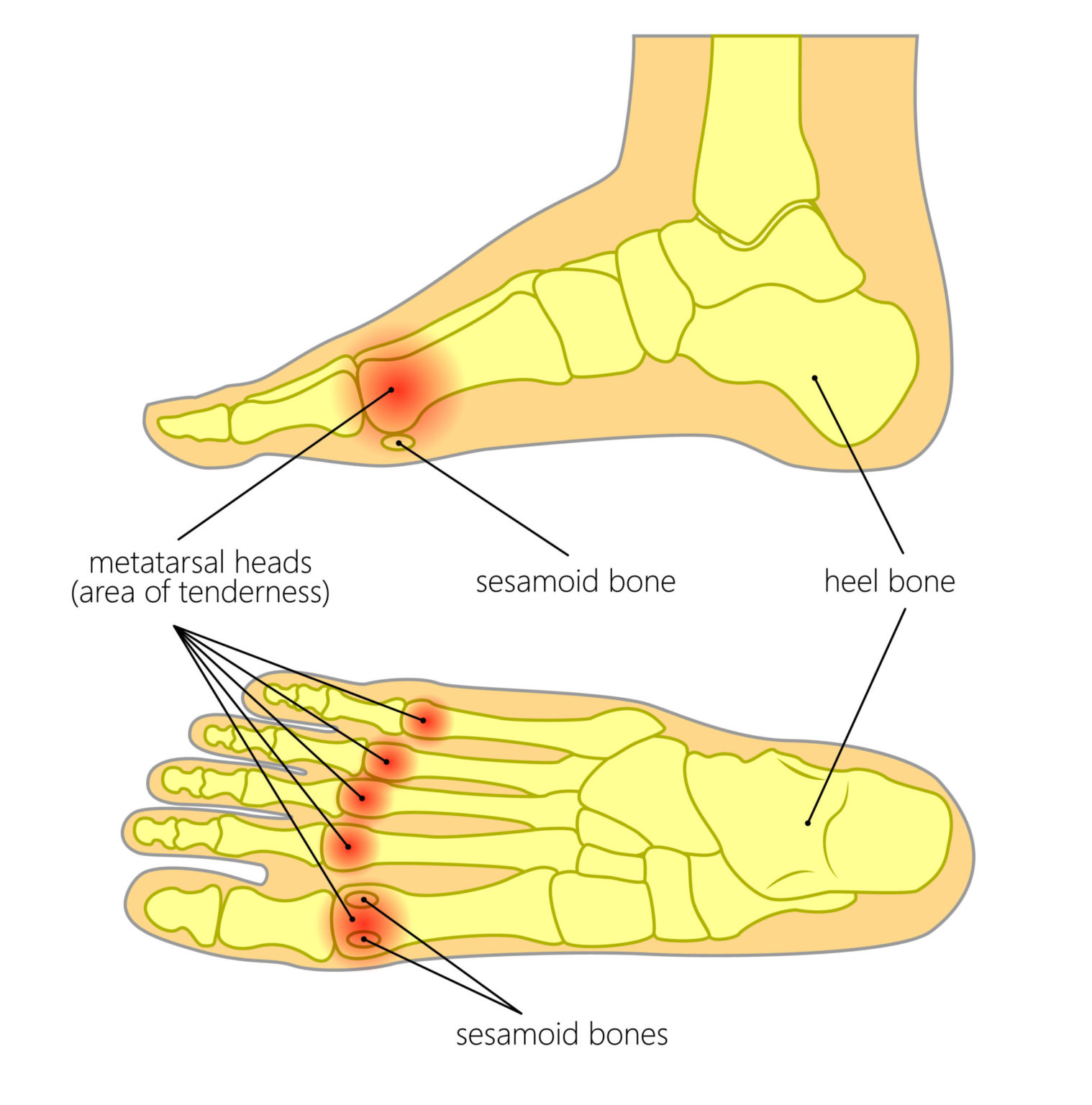 metatarsal-pain-metatarsalgia-marie-whitfield-podiatry-ball-of