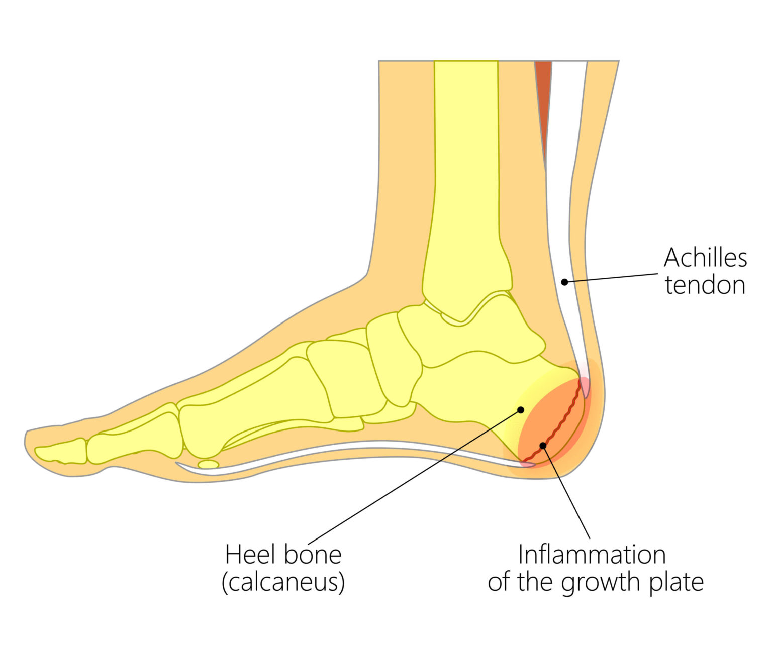 Sever’s Disease - Marie Whitfield Podiatry